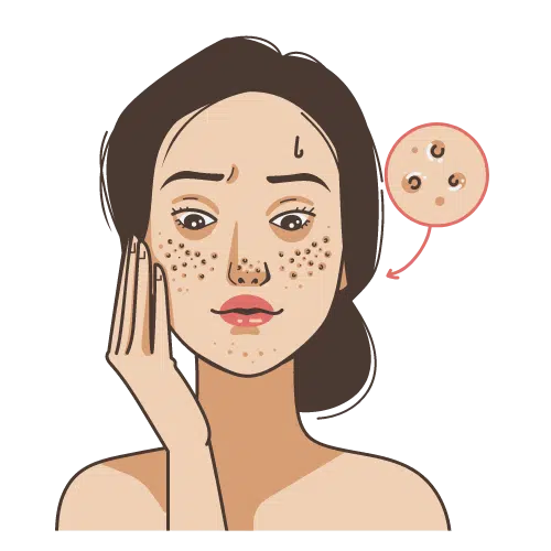 Microneedling Facial at Ala Care MedSpa for Skin Rejuvenation and Benefits