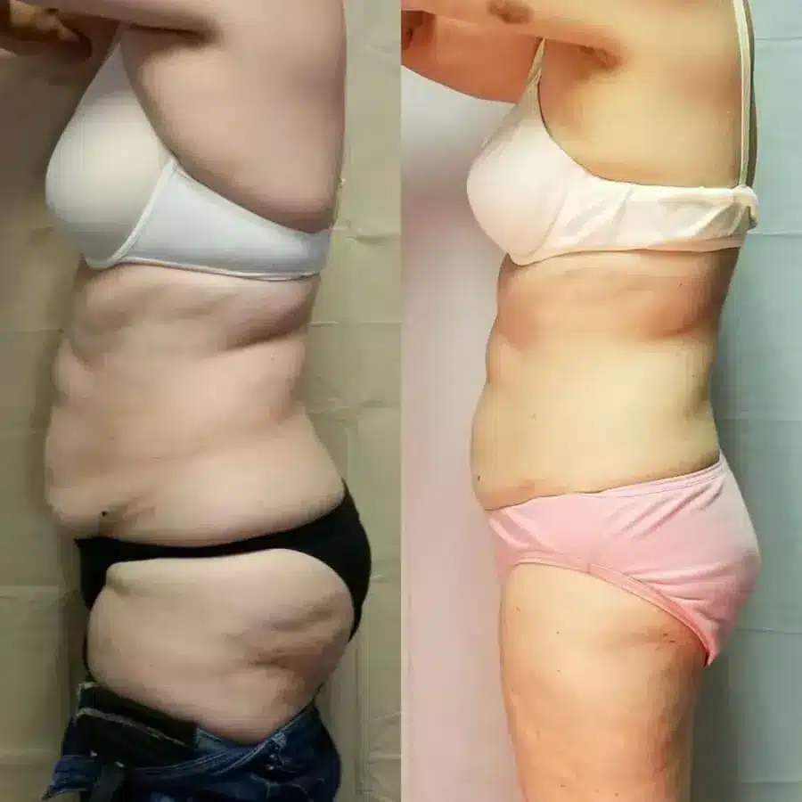best weight loss program weight loss program near me weight loss injections weight loss clinic near me weight loss clinic | Slim Shot Injections for Weight Loss and Health Benefits at Ala Care MedSpa